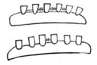 Ligation for steadying teeth