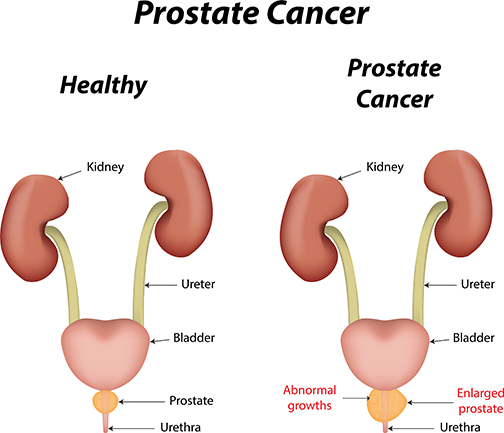 ProstateCancer