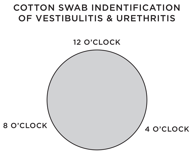 Cotton swab identification of vestibulitis and urethritis