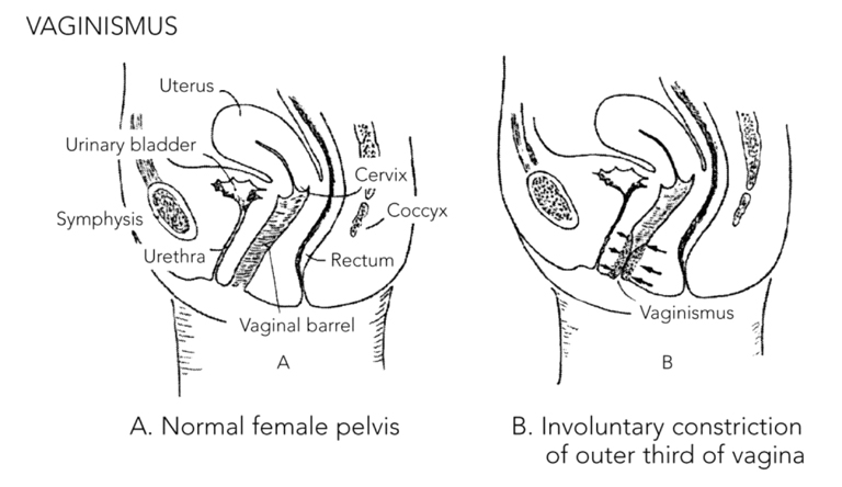 Vaginismus: A. Normal female pelvis. B. Involuntary constriction of outer third of vagina.