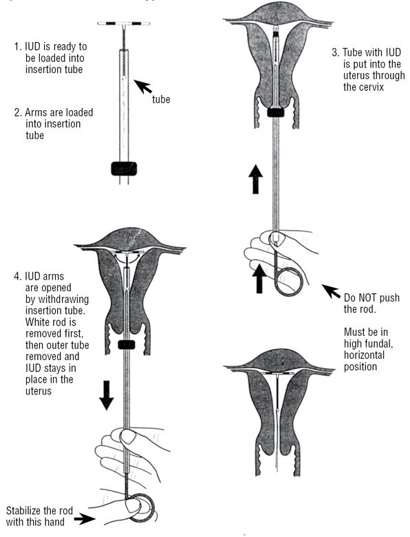 ManagingContraceptiontFINAL.pdf