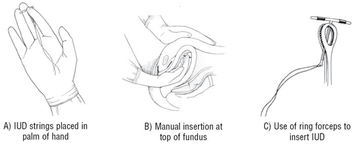 ManagingContraceptiontFINAL.pdf