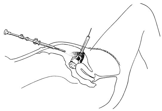 3230ch25tubalsterilization