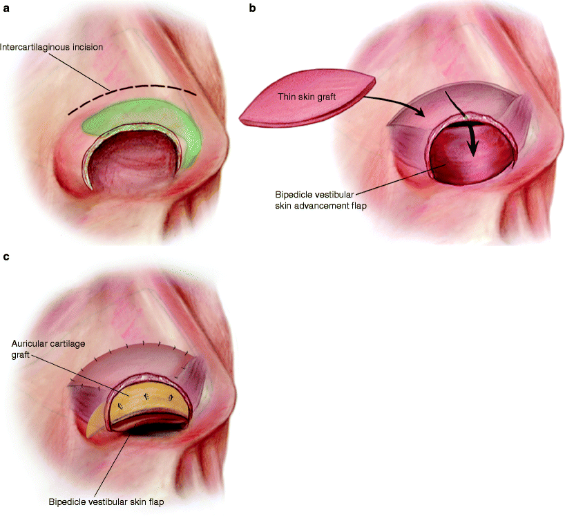 A978-0-387-89028-9_4_Fig2_HTML.gif