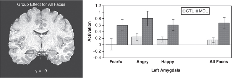 (Left) Image of a human brain and (right) graph depicting activation of the left amygdala of adolescents in a control group (CTL) and in those with a disorder at the major depressive level (MDL) who were shown fearful, angry, and happy faces.