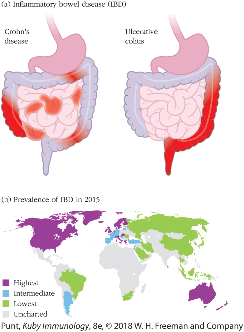 A two-part illustration shows the two different types of inflammatory bowel diseases (IBD) and a graph that shows the prevalence of IBD in 2015 around the world