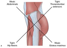 Figure 1.11 Muscle imbalances found in lower and upper crossed syndrome.