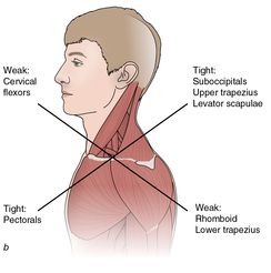 Figure 1.11 Muscle imbalances found in lower and upper crossed syndrome.