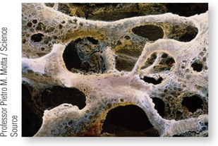 Photograph of human bone with small and large holes in them.