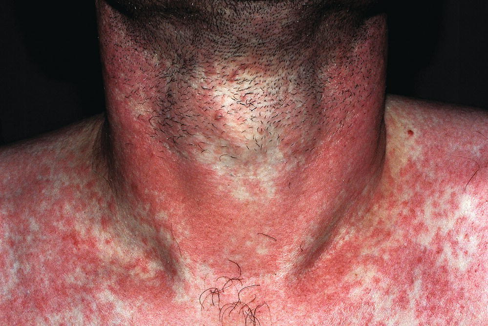 Neck and shoulders of a patient with erythema due to a drug reaction.