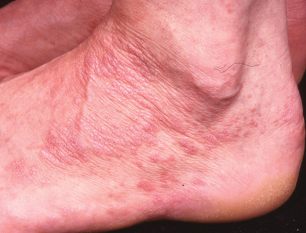 Lateral view of the left foot of a patient with papules in lichen planus.