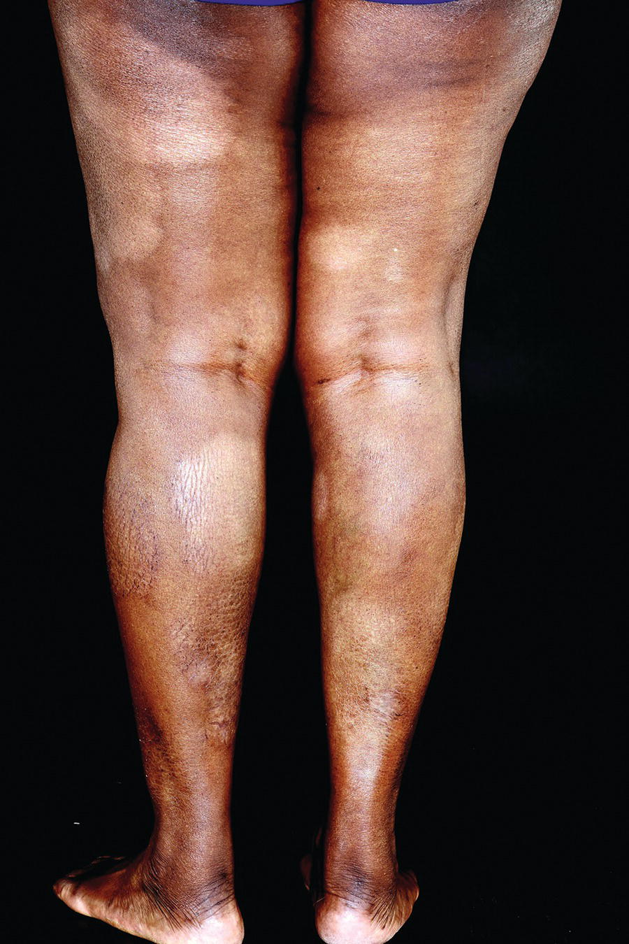 Posterior view of the legs of a patient with symmetrical hypopigmented plaques of cutaneous T‐cell lymphoma.