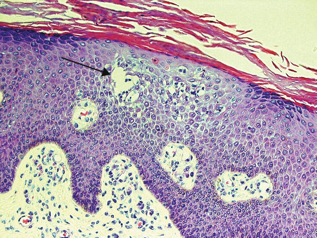 Micrograph of eczema with arrow indicating intraepidermal vesicle (arrow).