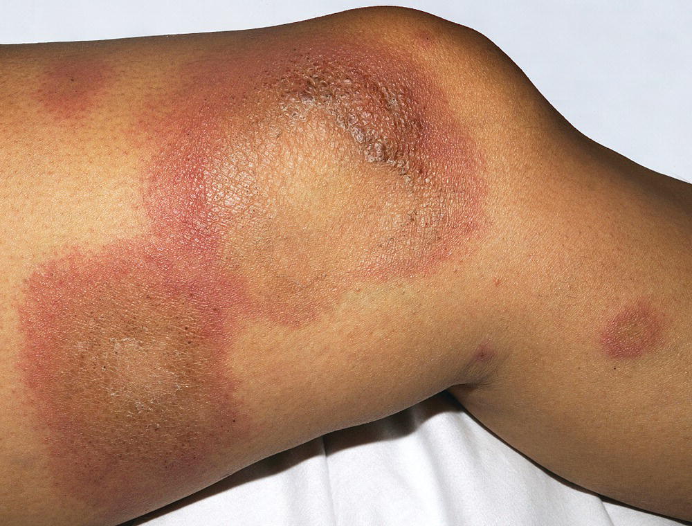 Urticarial vasculitis with bruising on the upper leg of a patient.