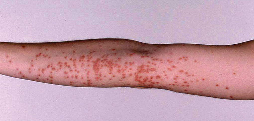 Arm of the patient with urticaria from contact with brown caterpillar moths.