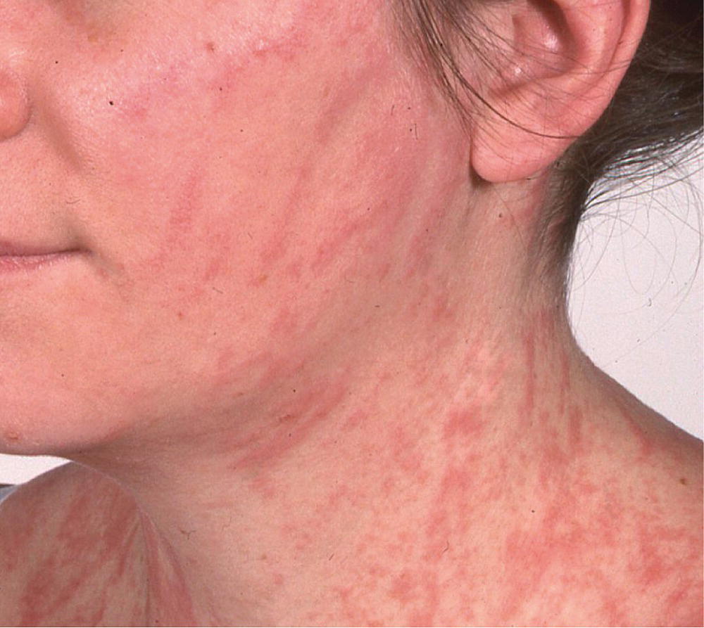 Ordinary urticaria with dermatographism on the cheek and neck of a patient.