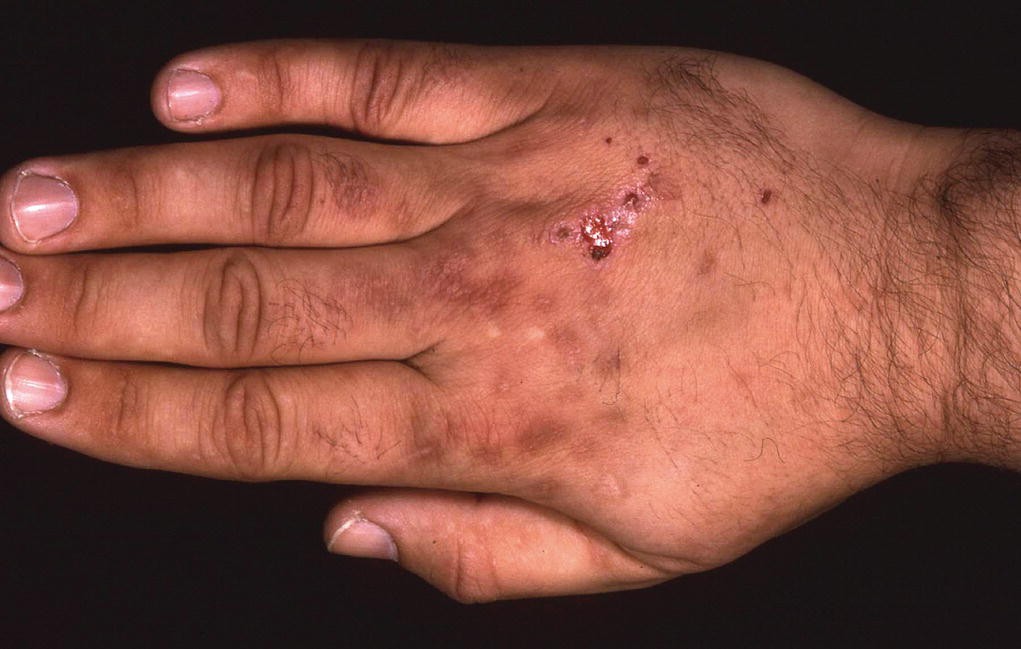 Porphyria cutanea tarda on a hand.