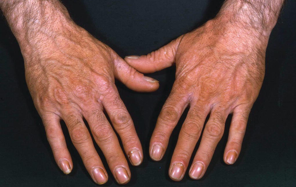 Erythropoietic protoporphyria on hands.