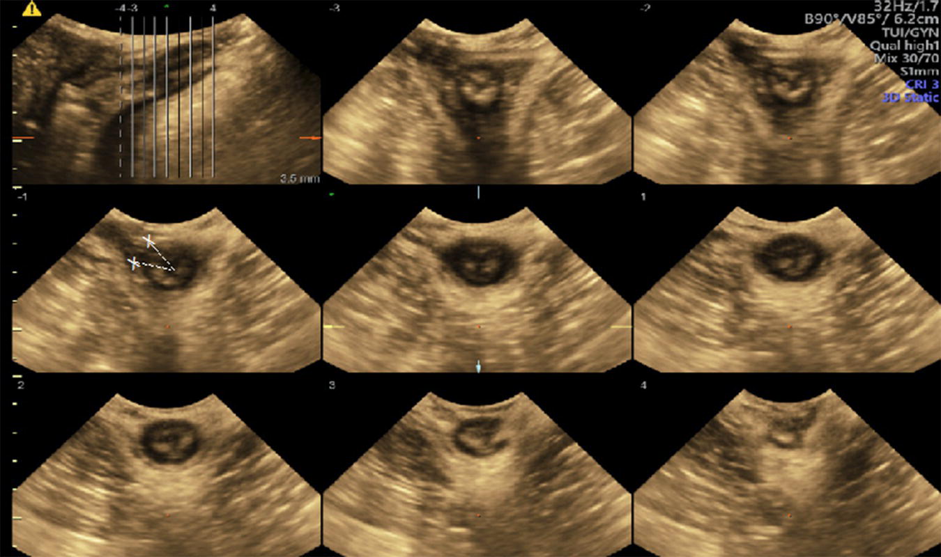 Photo depicts TUI sub-analysis of a 3-dimensional volume TPUS of a normally attached levator ani upon muscle contraction.