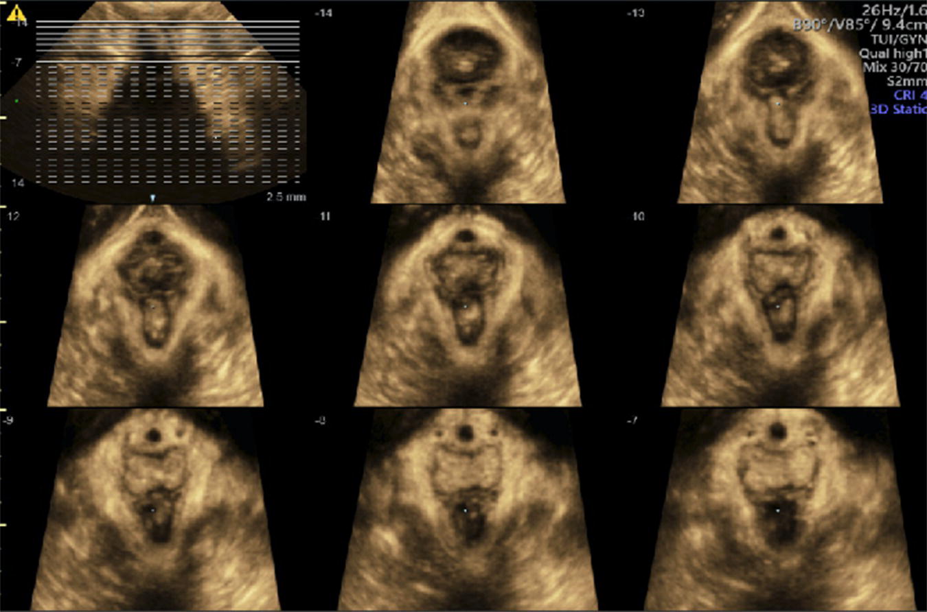 Photo depicts 3-dimensional Axial view of a unilateral right sided levator avulsion.