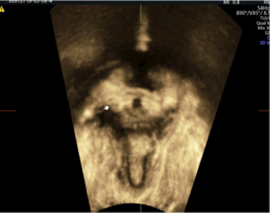 Photo depicts TUI sub-analysis of a 3-dimensional volume TPUS of a unilateral right sided levator avulsion with a LUG of 27.9 mm.