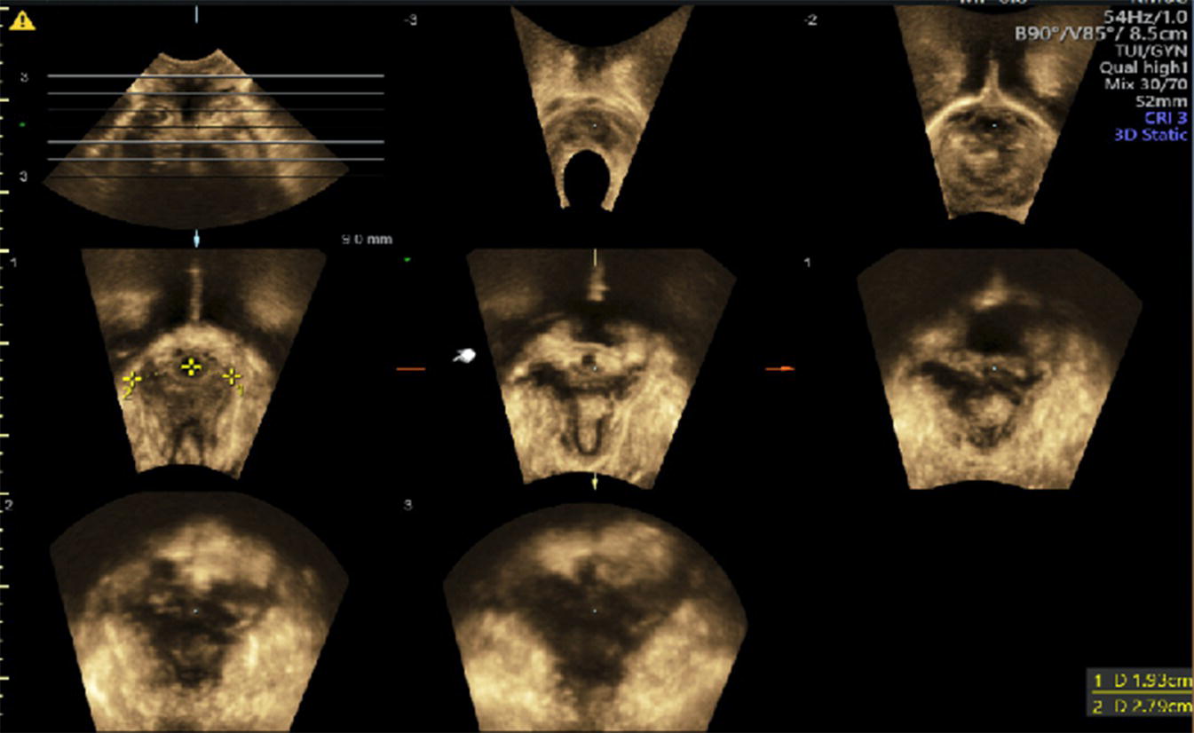 Photo depicts TUI sub-analysis of a 3D volume TPUS showing bilateral Levator avulsion.