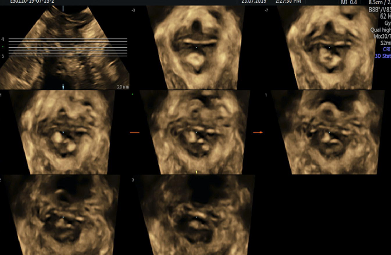 Photo depicts TUI sub-analysis of a 3D volume TPUS showing an EAS defect.