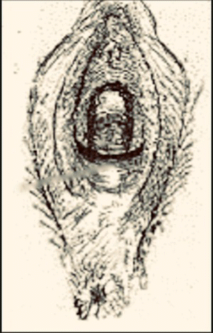 Schematic illustration of the band of scar tissue at the introitus part on parting the labia.