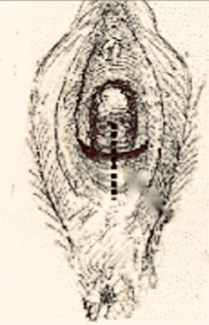 Schematic illustration of vertical incision.