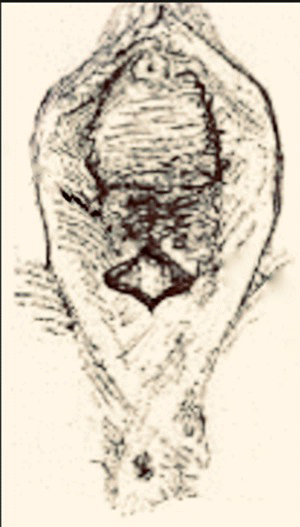 Schematic illustration of the dissection of underlying scar tissue.