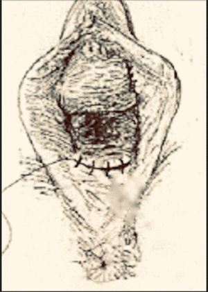 Schematic illustration of repaired across in two layers using continuous 3/0 polyglactin suture.