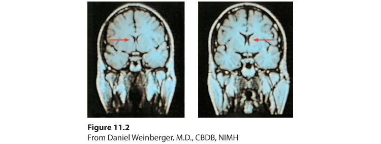 Image showing two MRI scans. The one on the left shows the brain of a healthy individual, and the one on the right that of a person with schizophrenia.