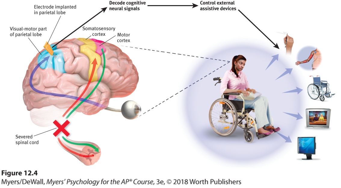 Diagram illustrating brain-computer interaction through the implantation of a chip on a patient with a sever spinal cord.