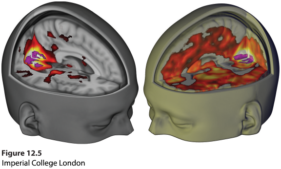 An illustration shows the M R I scan of a research participant under the influence of L S D and placebo.