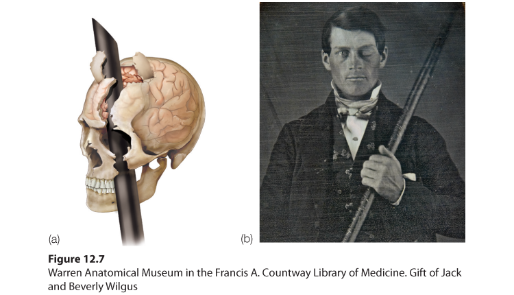 An illustration has two parts. Part (a) a photograph of a digitally reconstituted image of the path of the rod through Gage’s brain. Part (b) Photograph of railroad worker Phineas Gage after the accident.