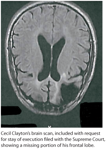 An illustration shows the brain scan of Cecil Clayton.