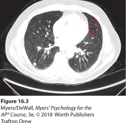 A photo shows a lung scan with a small gorilla figure highlighted on the right.