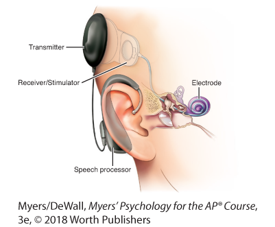 Diagram of a cochlear implant.