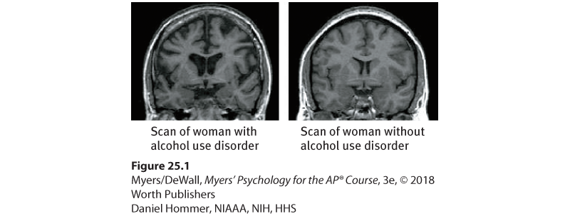 Two brain scans showing the effects of disordered drinking on the brain.