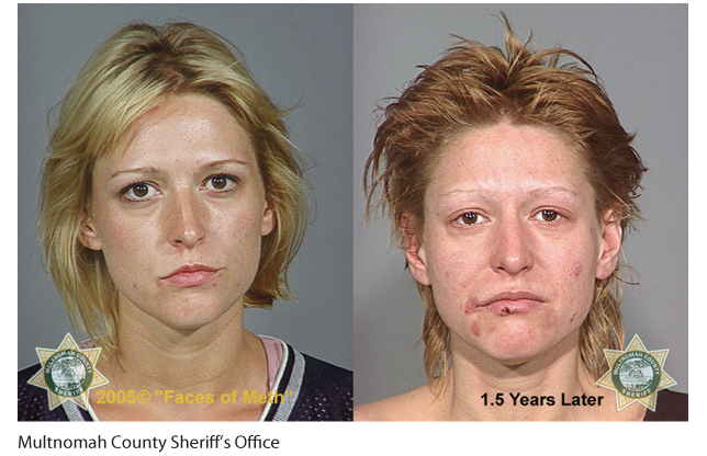 Two photos of a woman are shown depicting the physical changes caused by methamphetamine addiction.