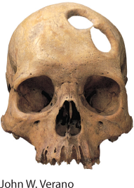 This picture shows a skull with two very large holes at the top left side, one by the center, one below. They are so close they form a figure 8.