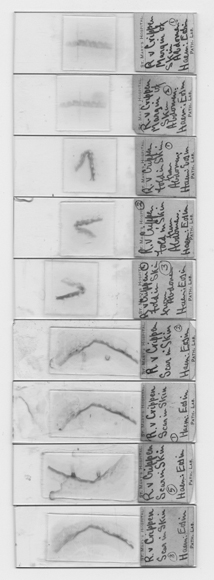 Una serie di vetrini utilizzati da Spilsbury per mostrare le sezioni della cicatrice rinvenute sul torso sepolto in cantina: secondo il patologo forense il torso sarebbe stato di Cora Crippen, ma non tutti erano d’accordo. (© The Royal London Hospital Archives and Museum)