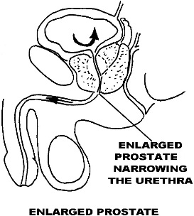 Enlarged Prostrate