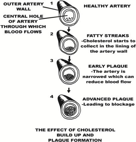 The Effect of Cholesterol Build up and Plaque Formation