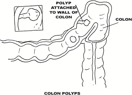 Colon Polys