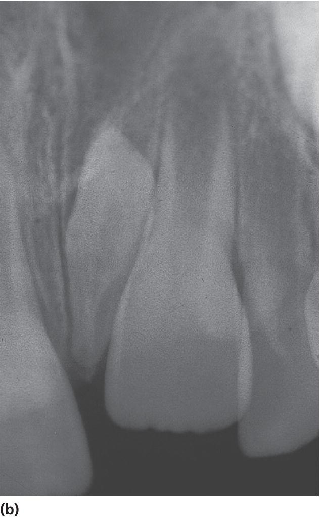 Radiograph displaying mesiodens.