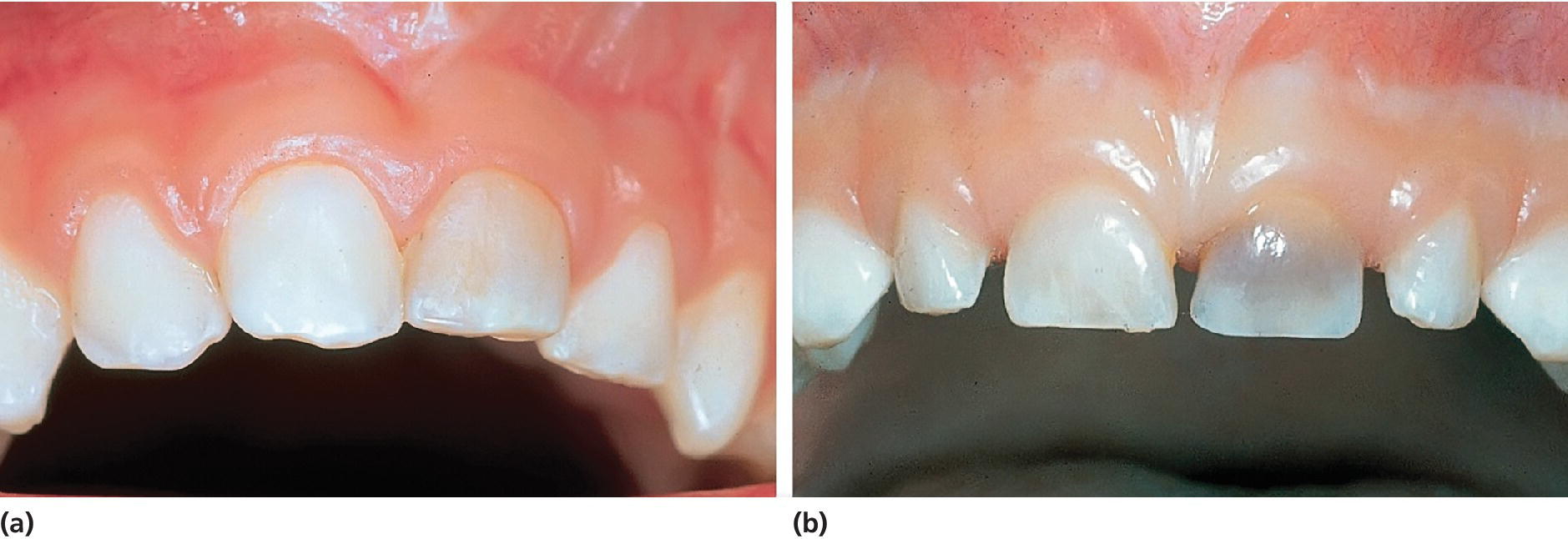 Two photos of the maxillary teeth, with one tooth (upper left central incisor) featuring discoloration.