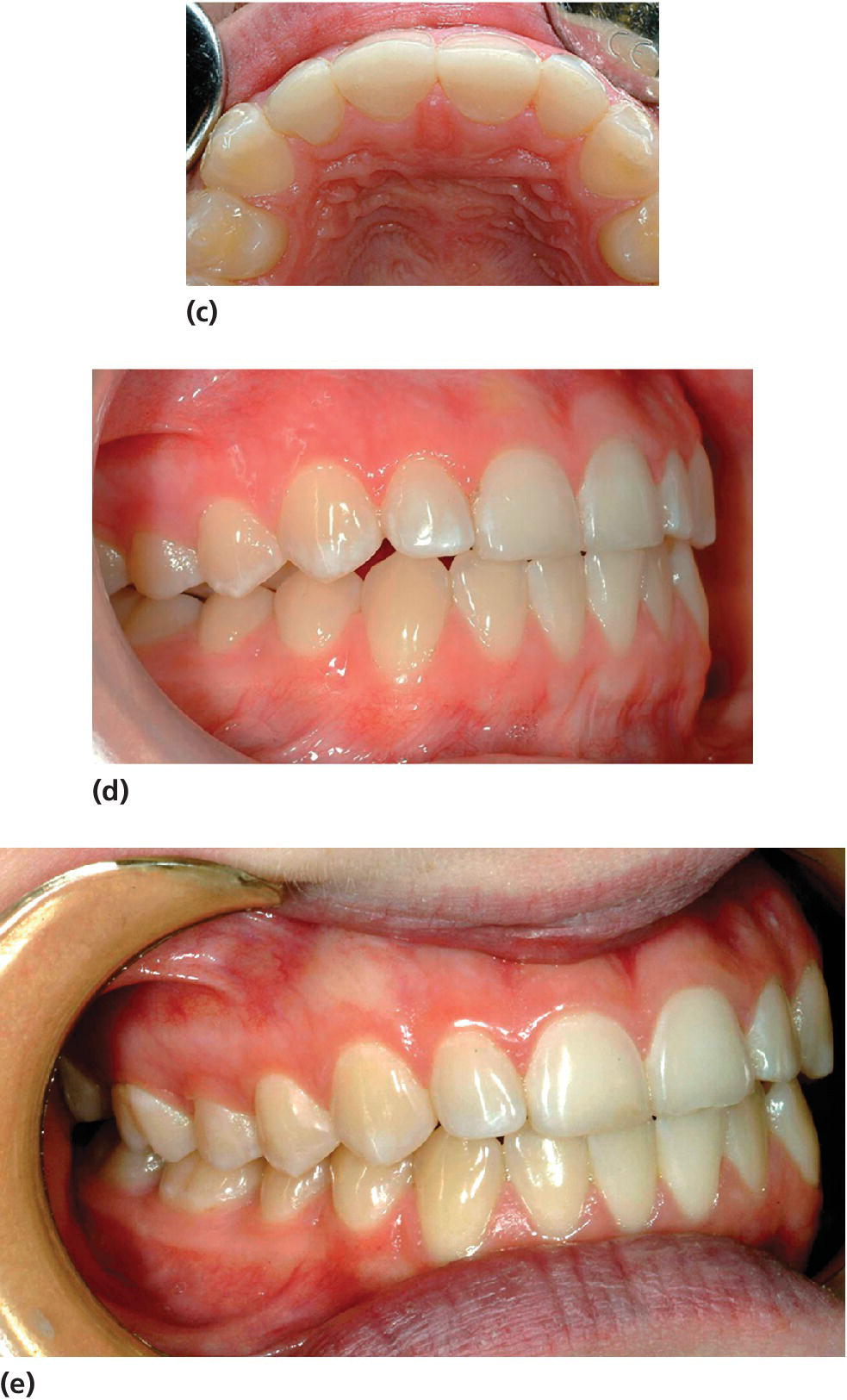 Photos of a patient’s maxillary teeth displaying vertical dimensions for restoring teeth 11, 21, and 22 (c) and bite presenting posterior disocclusion (d) and compensatory eruption and alveolar growth (e).