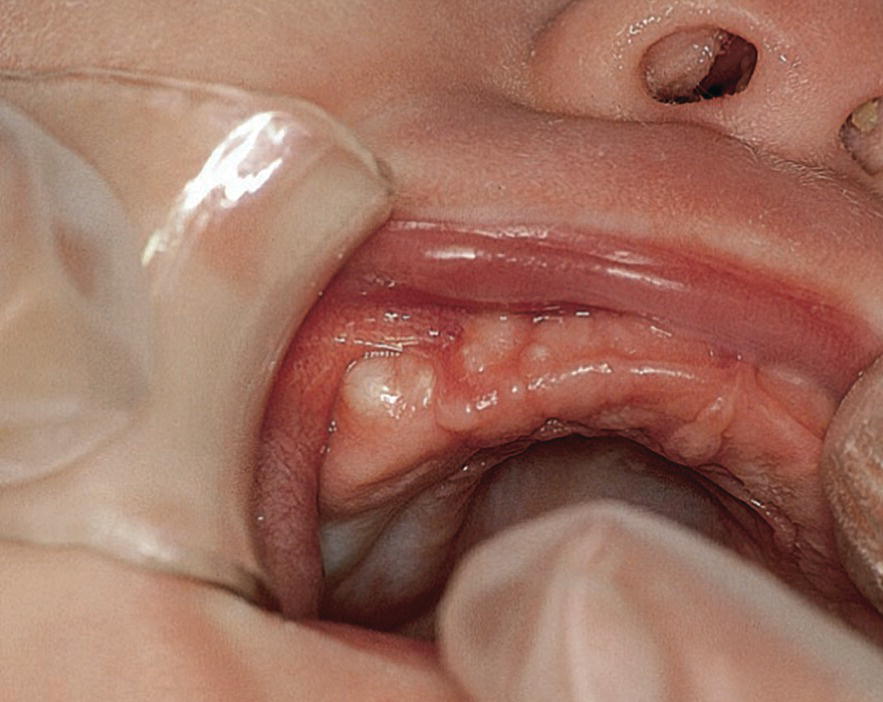 Photo displaying Bohn’s nodules on the maxillary gums of a newborn baby.