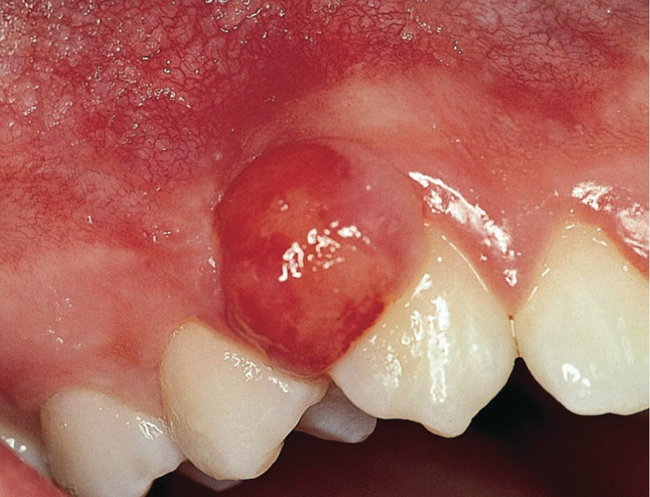 Photo displaying peripheral calcifying granuloma.